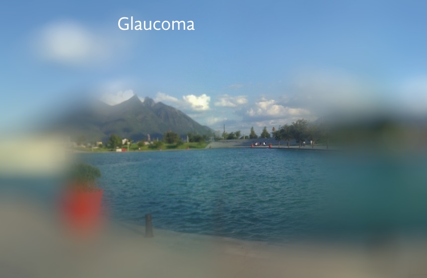 glaucoma monterrey