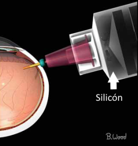 Silic N En El Ojo Archives Oftalm Logo En Monterrey Dr Alberto Ruiz